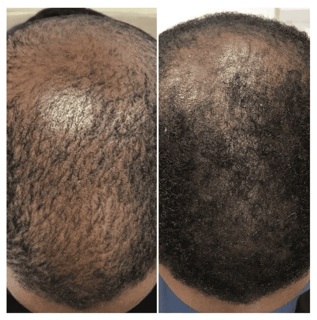 Visit The Headroom for Thinning Hair Solutions